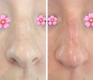 korekcja/modelowanie nosa